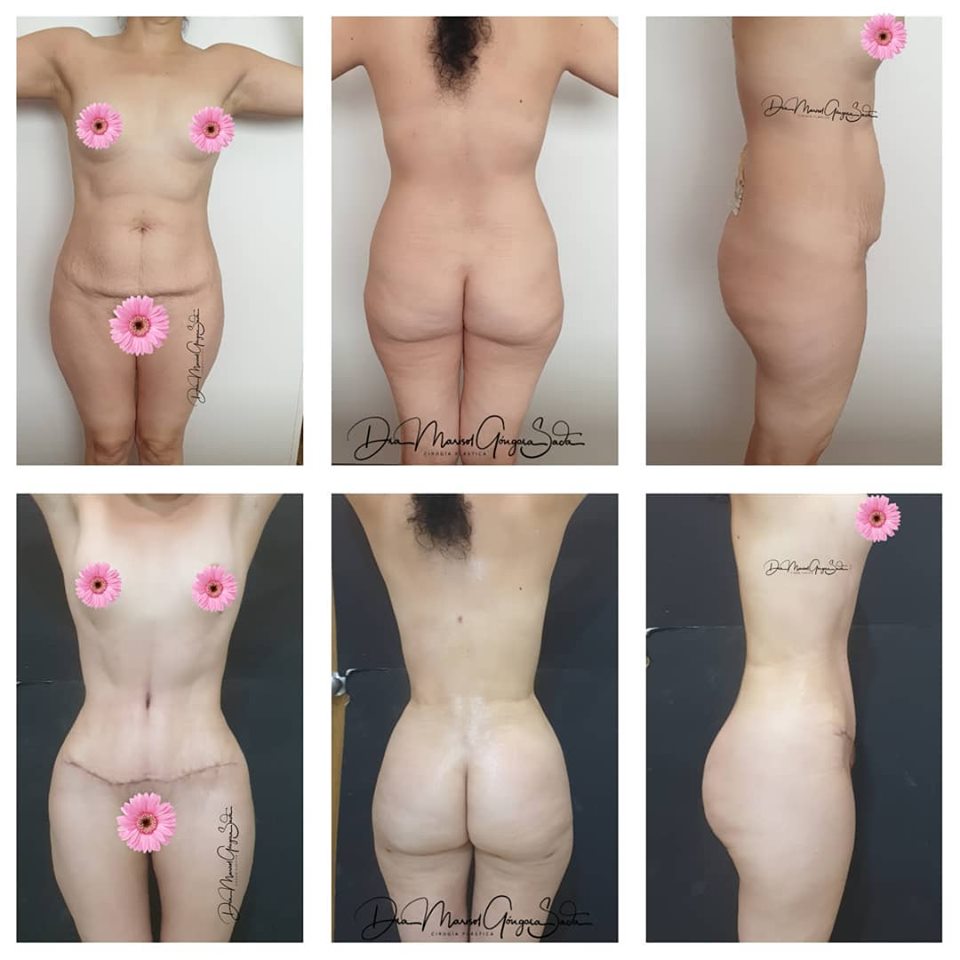 Lipo